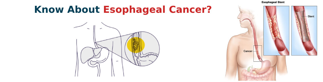 Know About Esophageal Cancer